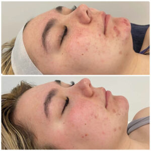 How to Fade Acne Scars Without Aggressive Treatments