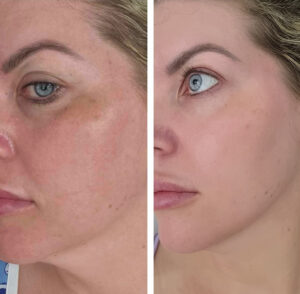 Pigmentation Treatment in Perth: Understanding Rebound Pigment and How to Treat It Properly