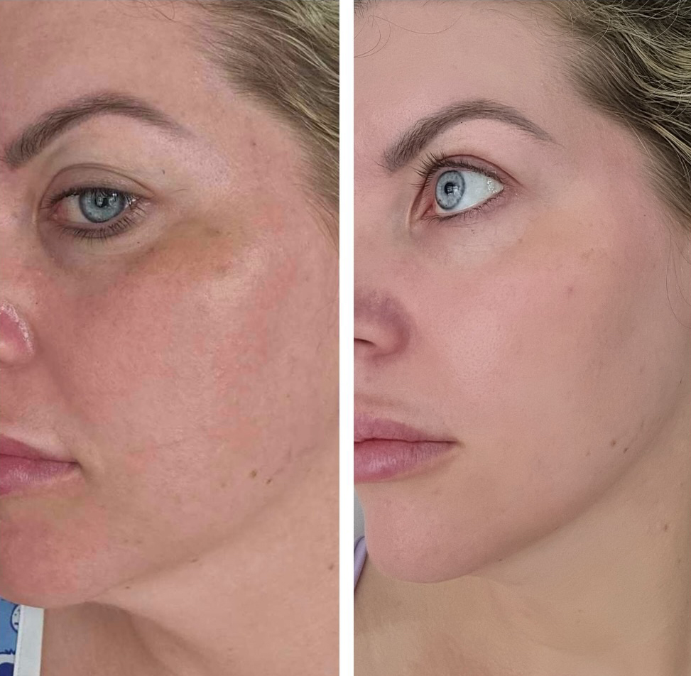 Pigmentation Treatment in Perth: Understanding Rebound Pigment and How to Treat It Properly