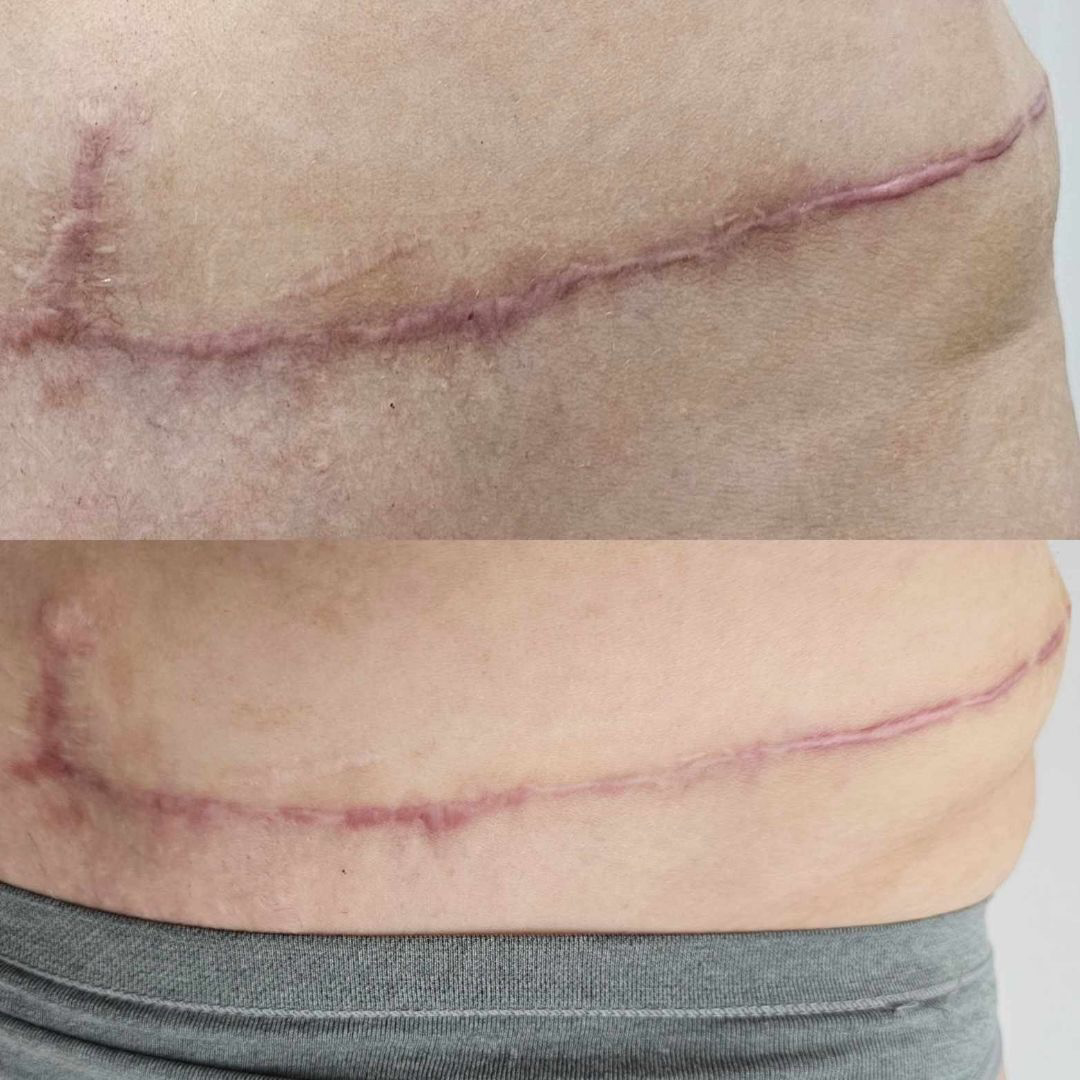 Scar healing takes time