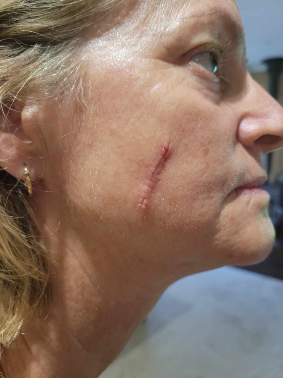Traumatic scar