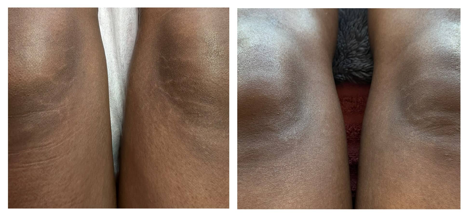 Before and after stretch mark revision
