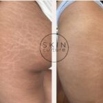 Stretch Mark Revision Explained