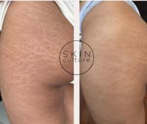 Stretch Mark Revision Explained: What Actually Works (And What Doesn’t)