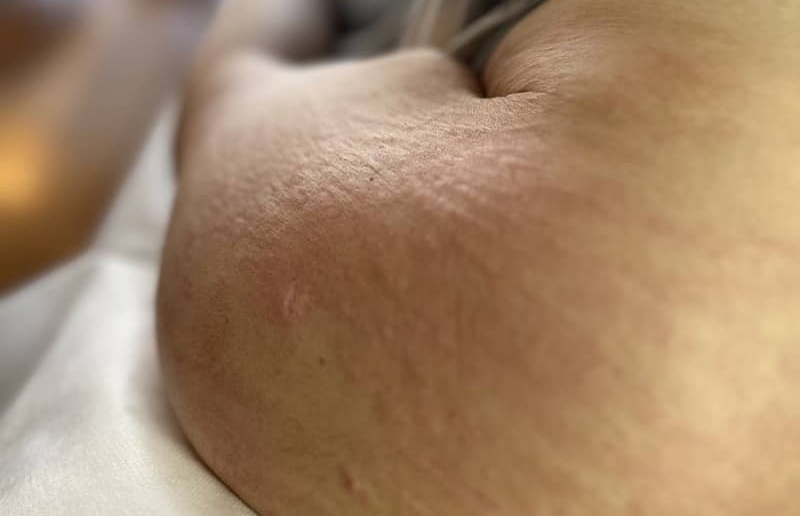 Stretch marks on arm