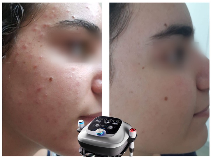 Before and after RF skin treatment