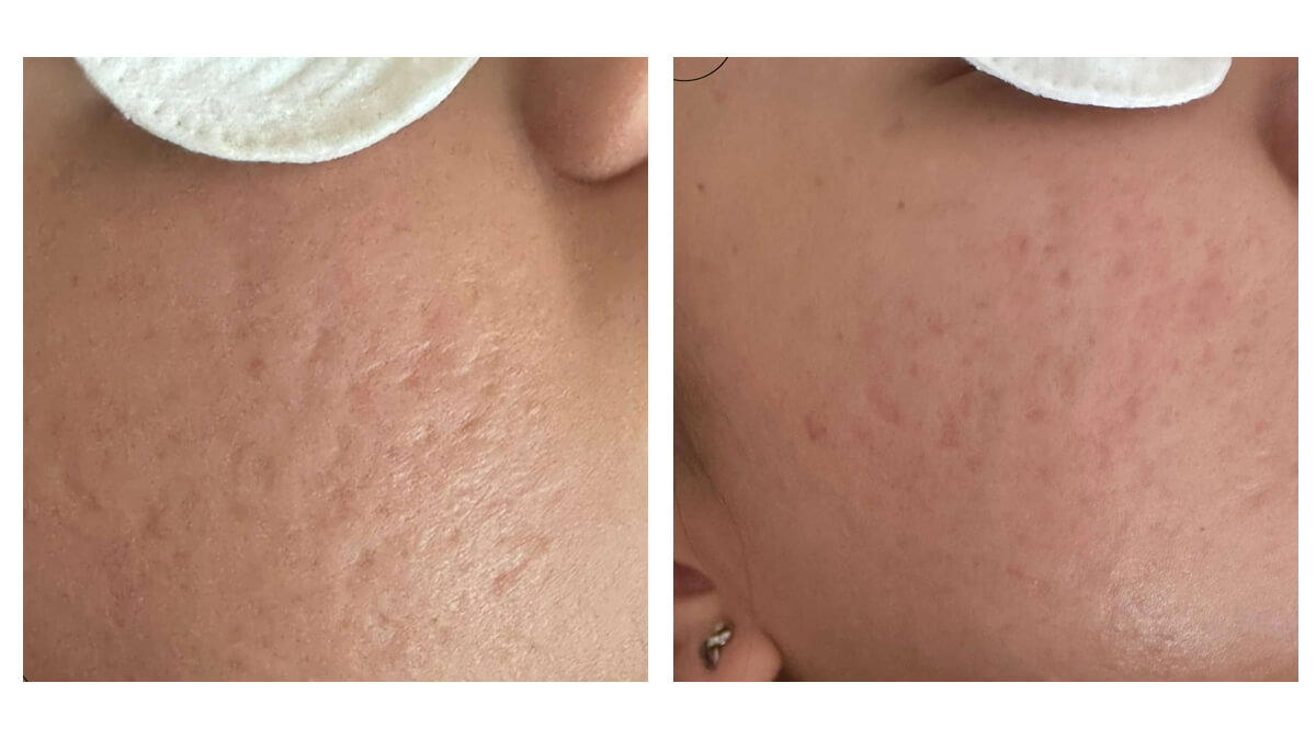 Before and after from skin treatments
