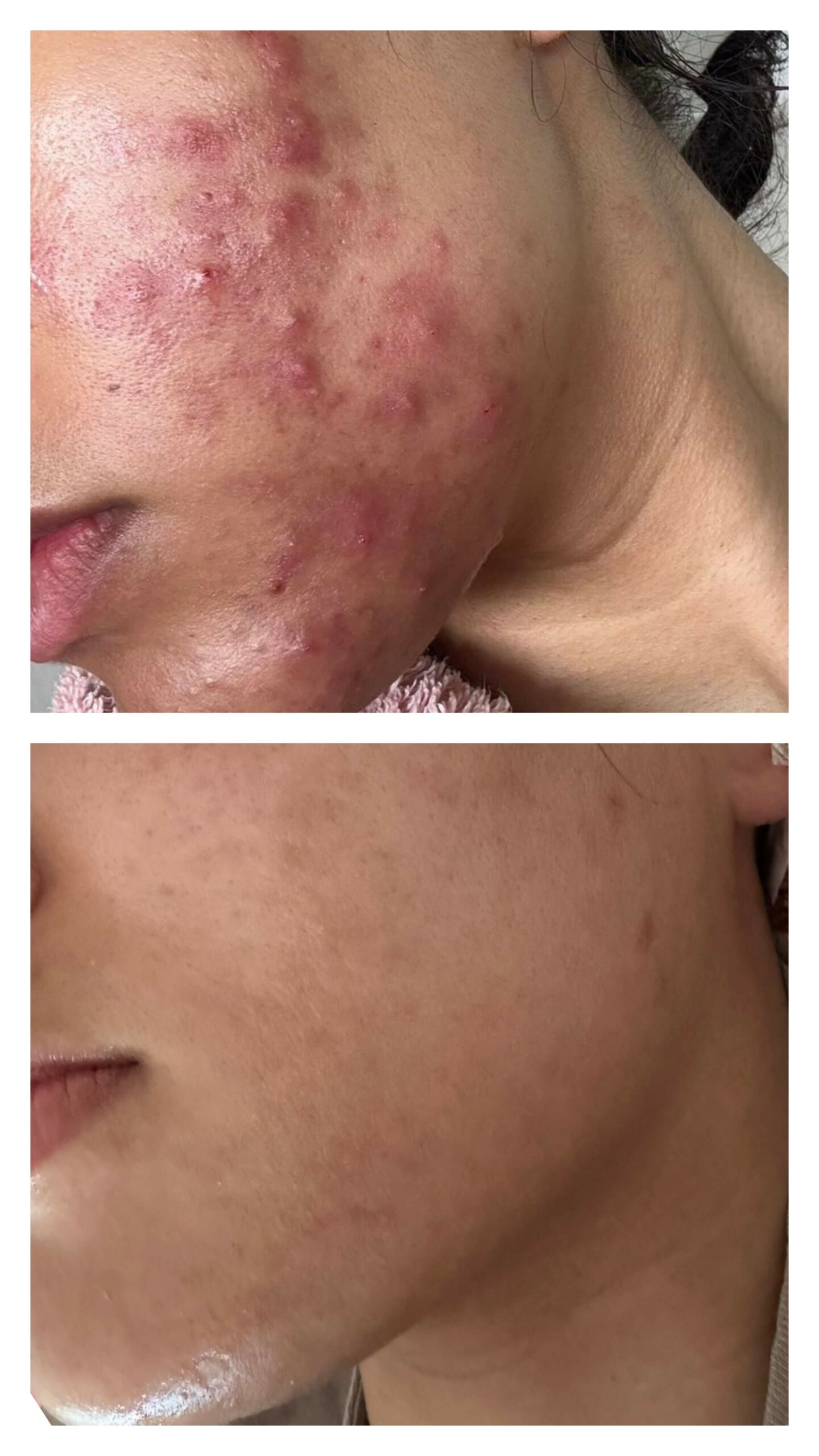 Best acne scar treatments