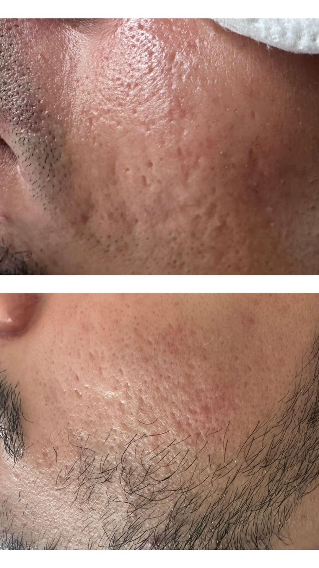 Best acne scar treatments