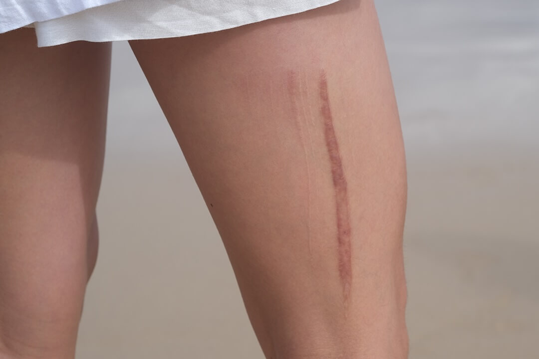 Dark Scar Neutralisation