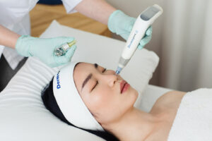 What Is Microneedling and How Does It Repair Skin Conditions