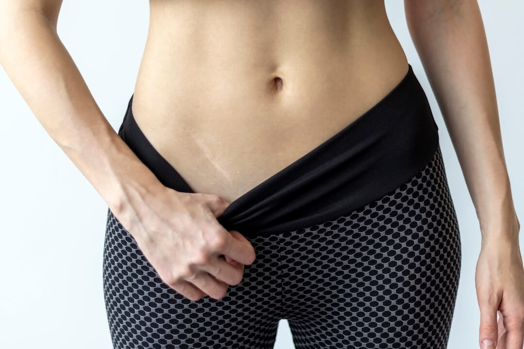 Light Scar and Stretch Mark Camouflage