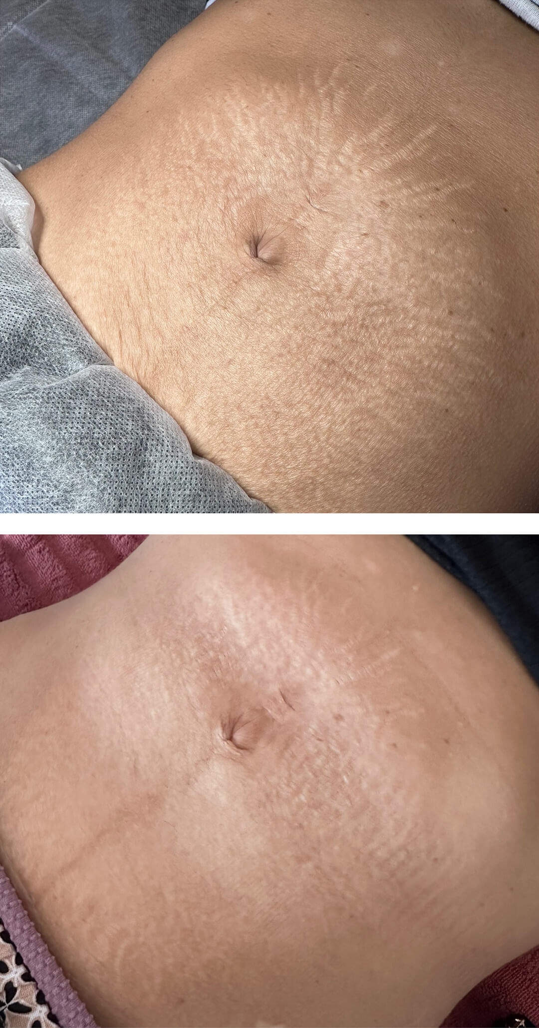 Before and After Stretch Mark & Scar Treatment