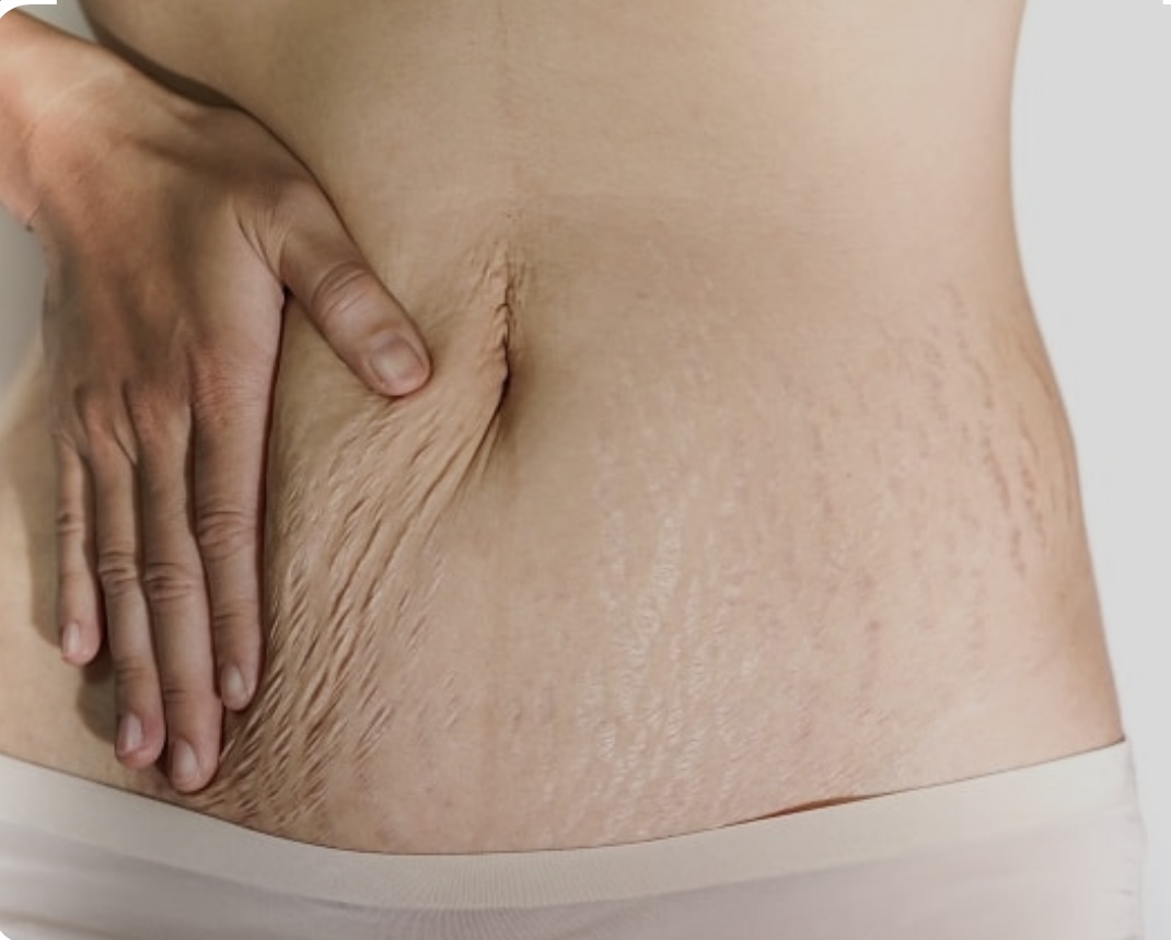 Stretch marks on stomach