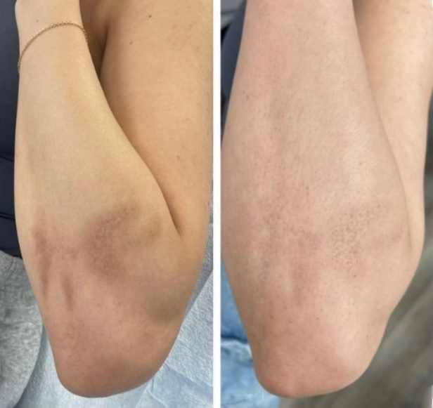 Dark Scar Neutralisation