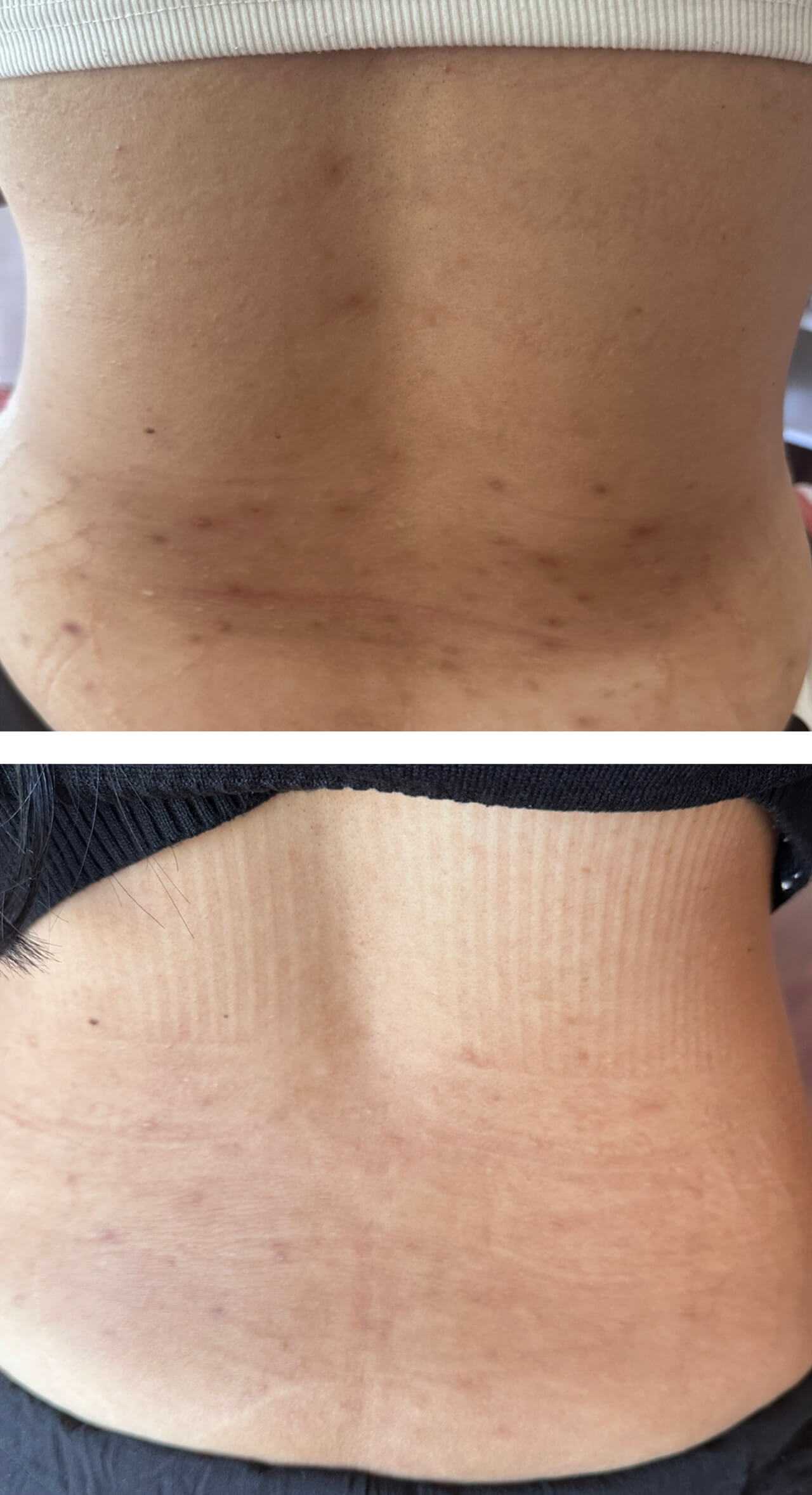 Dark scar treatment