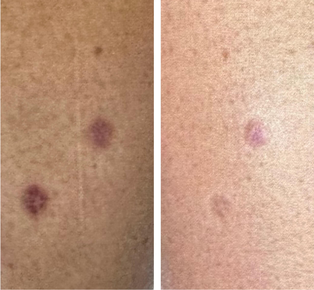 Fix dark scars