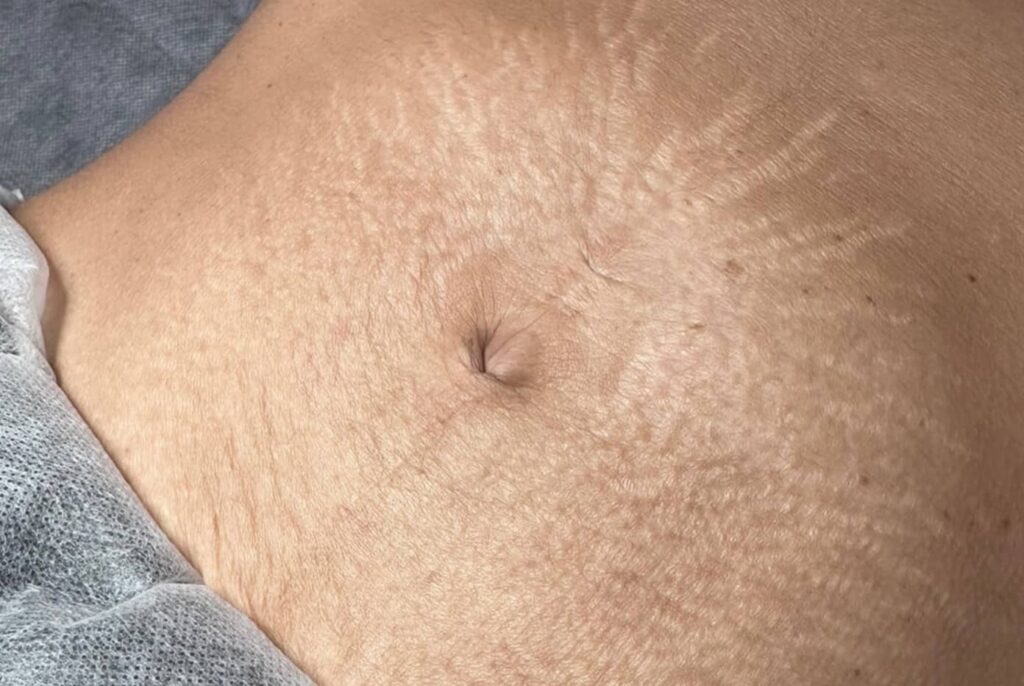 How Can You Remove Stretch Marks After Pregnancy