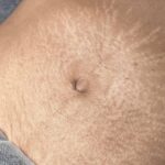 Removing stretch marks after pregnancy